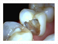 右上の小臼歯